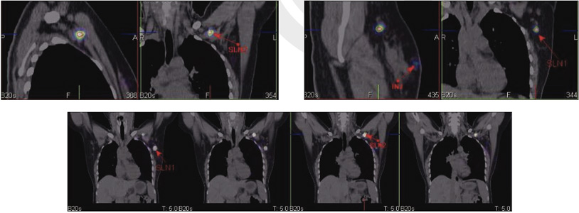 Lymphatic-Sentinel-Lymph Node-Scintigraphy