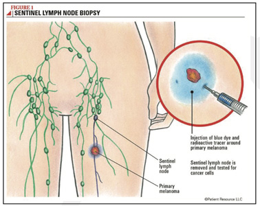 Lymphatic-Sentinel-Lymph Node-Scintigraphy