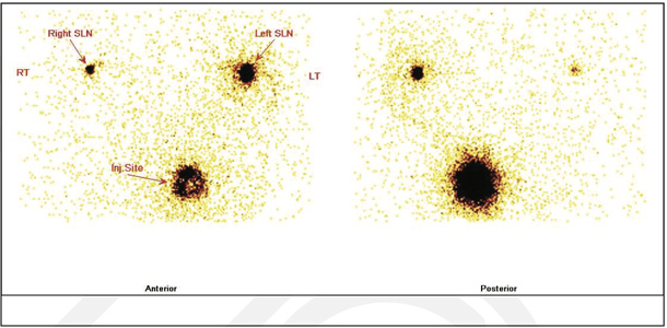 Lymphatic-Sentinel-Lymph Node-Scintigraphy