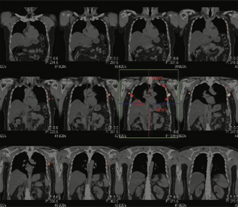 Lymphatic-Sentinel-Lymph Node-Scintigraphy
