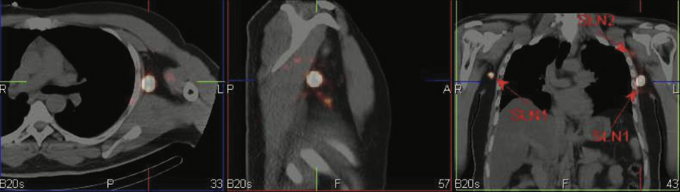 Lymphatic-Sentinel-Lymph Node-Scintigraphy