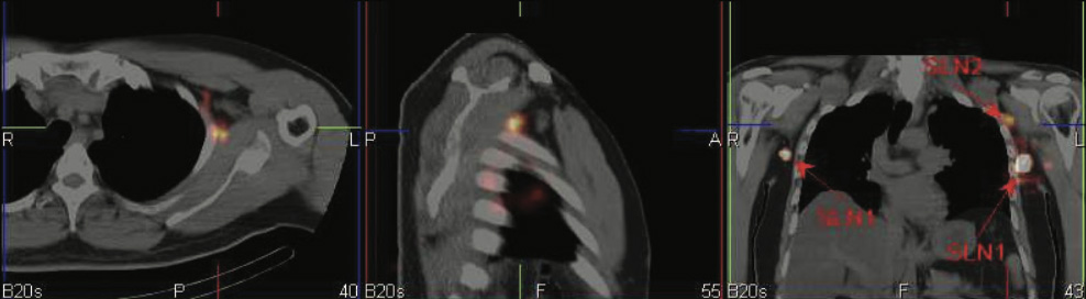 Lymphatic-Sentinel-Lymph Node-Scintigraphy