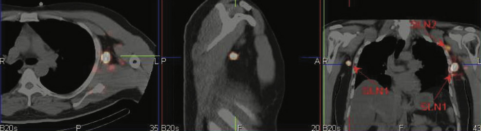 Lymphatic-Sentinel-Lymph Node-Scintigraphy