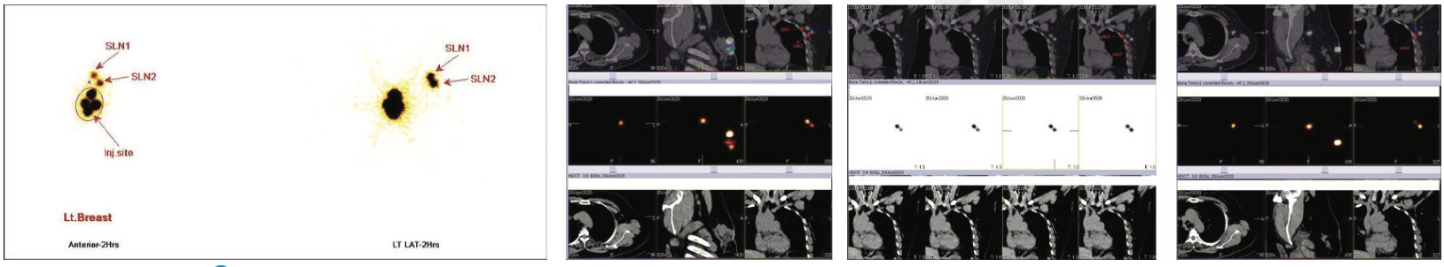 Lymphatic-Sentinel-Lymph Node-Scintigraphy