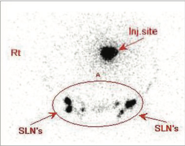 Lymphatic-Sentinel-Lymph Node-Scintigraphy