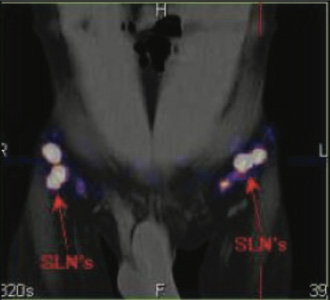 Lymphatic-Sentinel-Lymph Node-Scintigraphy