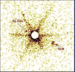 Lymphatic-Sentinel-Lymph Node-Scintigraphy