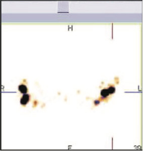 Lymphatic-Sentinel-Lymph Node-Scintigraphy