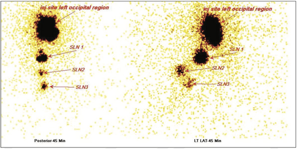 Lymphatic-Sentinel-Lymph Node-Scintigraphy
