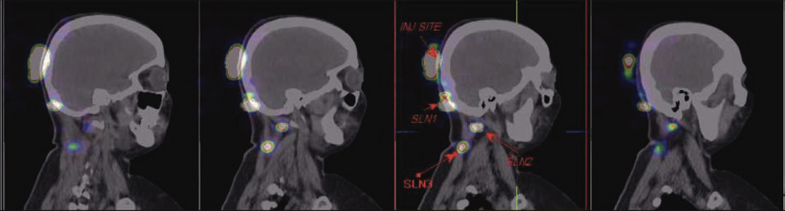 Lymphatic-Sentinel-Lymph Node-Scintigraphy