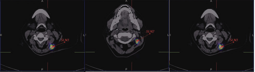 Lymphatic-Sentinel-Lymph Node-Scintigraphy