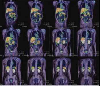 Oncology
