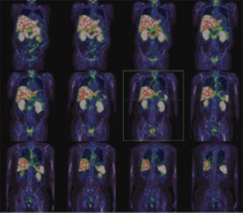 Oncology
