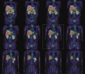 Oncology